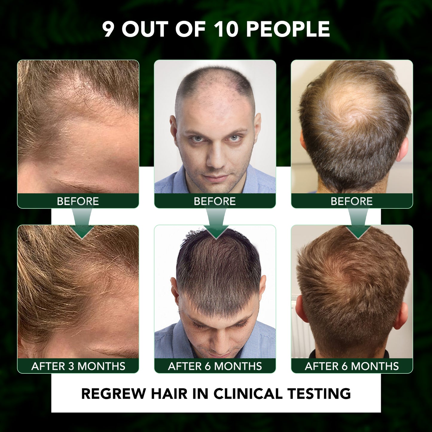 Minoxidil 5% Topical Solution Spray Treatment
