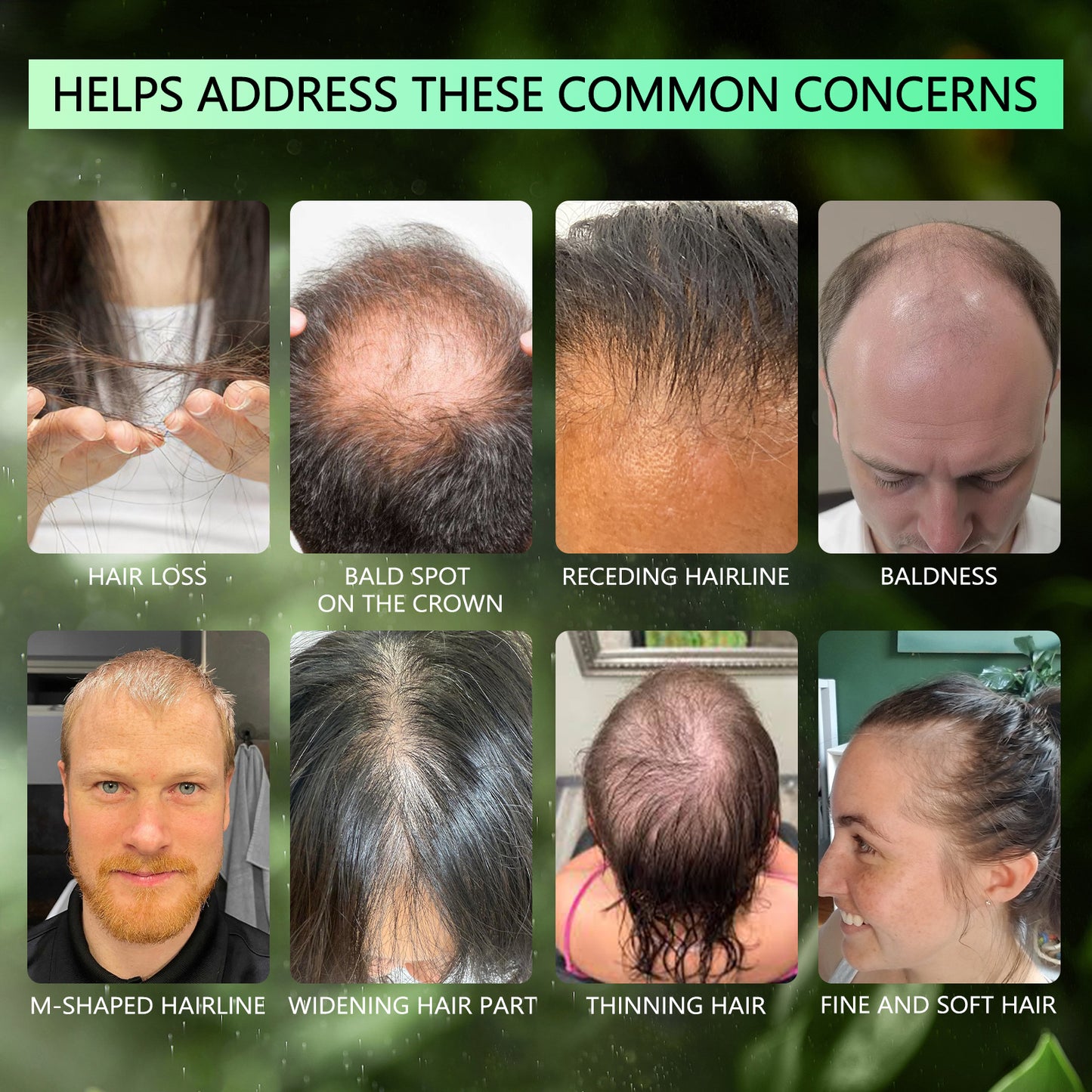 Minoxidil 5% Topical Solution Spray Treatment
